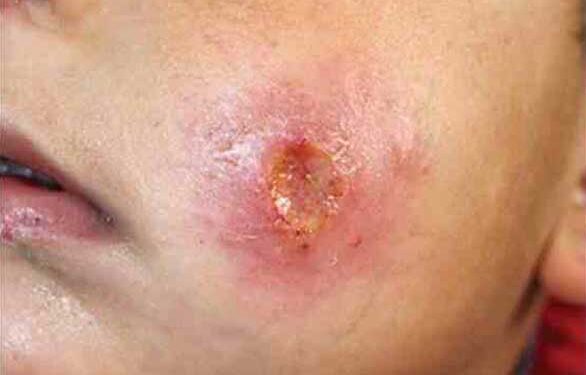 تفشي “حبة السنة” في الهيشة شمال الرقة يثير مخاوف الأهالي وسط عجز طبي واضح